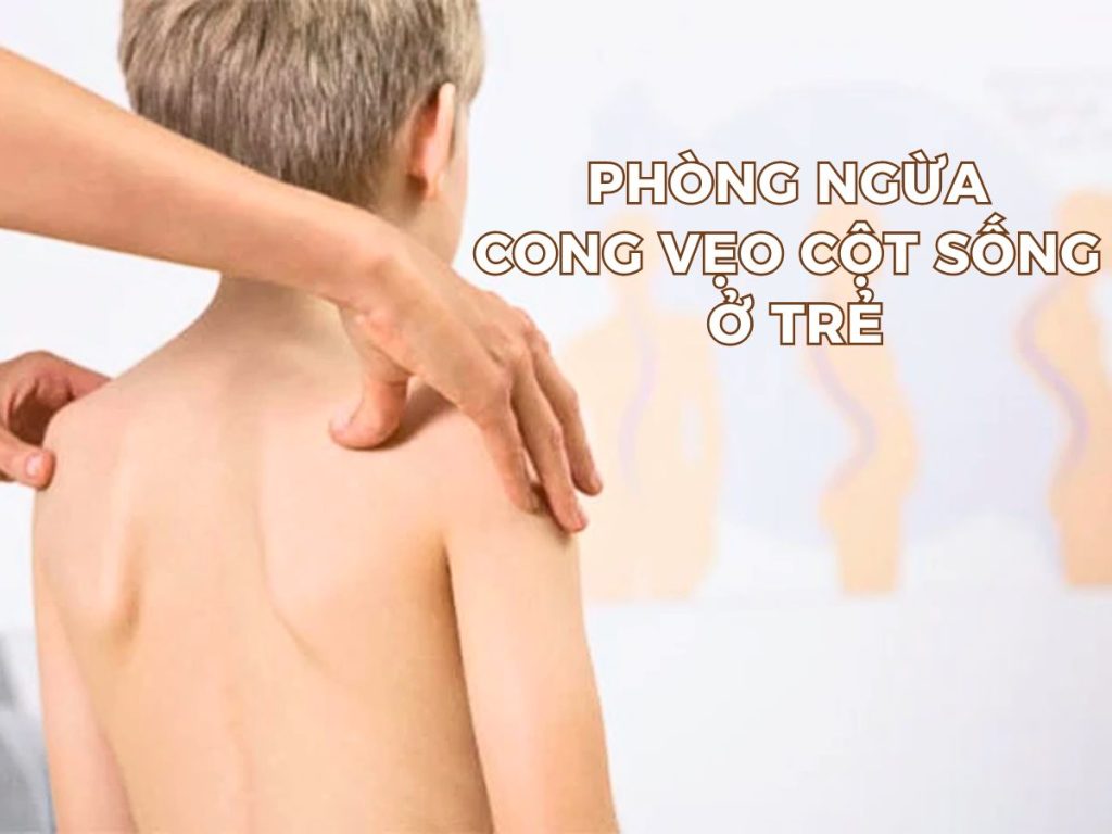 Phòng Ngừa Cong Vẹo Cột Sống Ở Trẻ