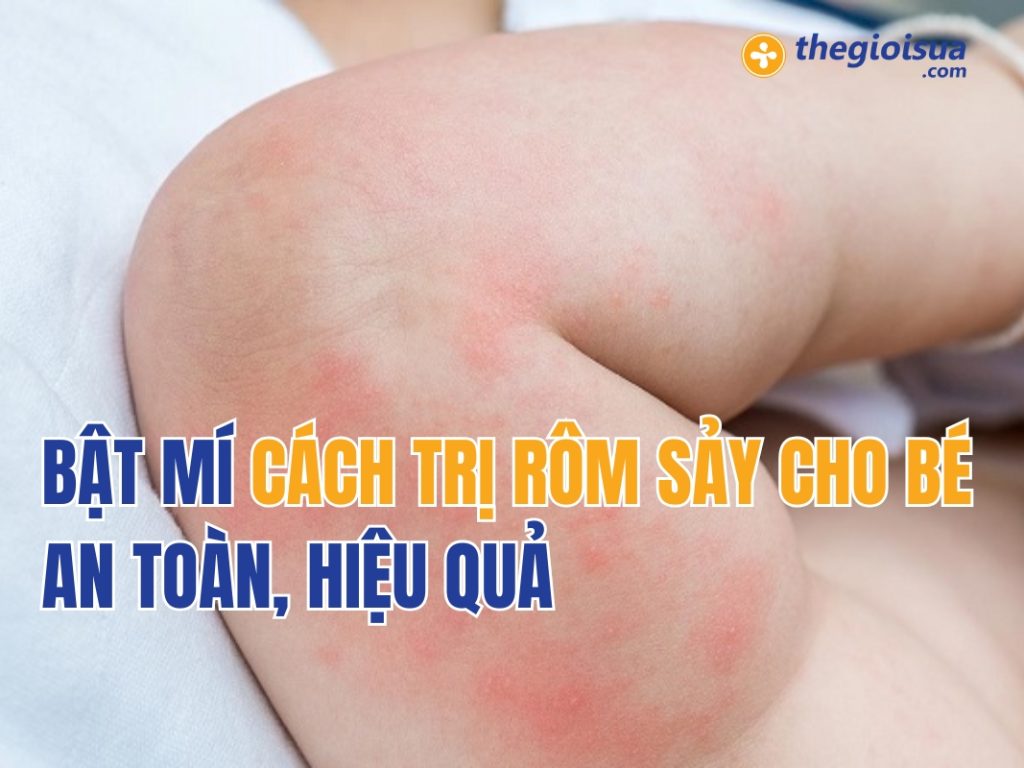 Bật Mí Cách Trị Rôm Sảy Cho Bé An Toàn, Hiệu Quả